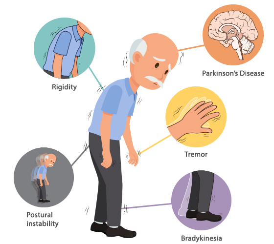 Parkinson’s Disease – Physiotherapy Management.
