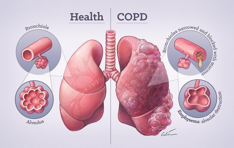 What is COPD