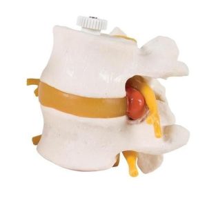 2 Lumbar Vertebrae with Prolapsed Disc, Flexibly Mounted