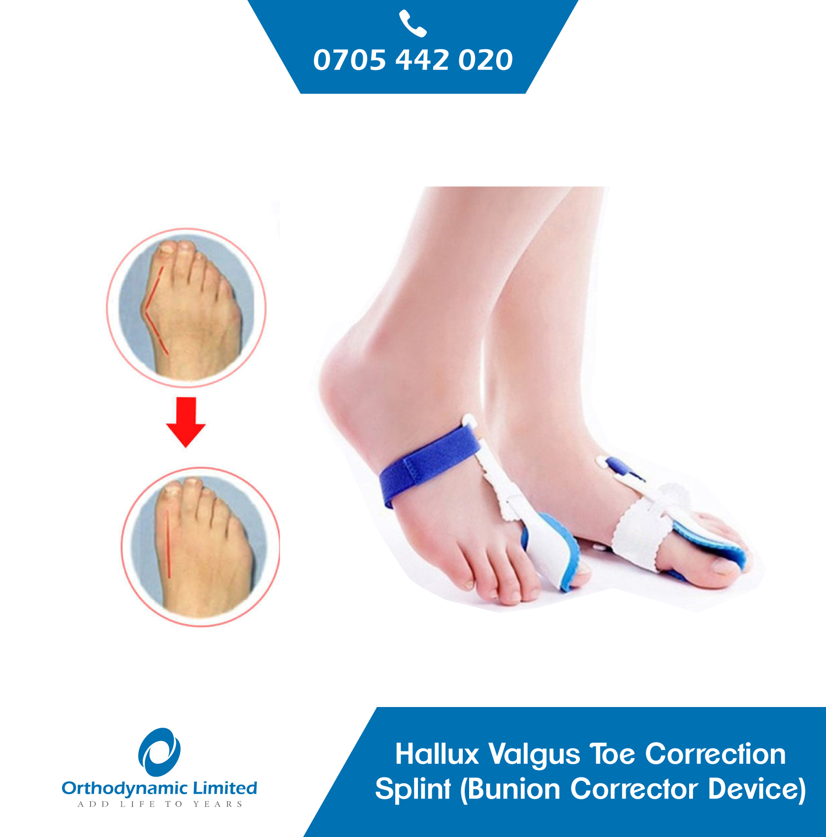 Hallux-valgus-Toe-Corrector-.jpeg